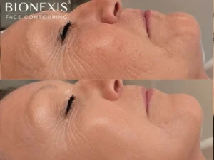 Acne facial