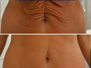 Bionexis Zemits Cavitation