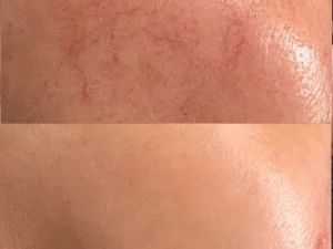 Cynosure elite IQ spider vein