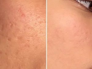 HydraFacial