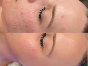 Hydrafacial 1