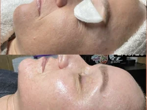 Hydrafacial 3