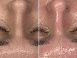 Hydrafacial 4