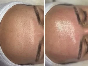 Hydrafacial 5