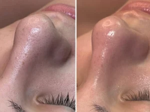 Hydrafacial 6