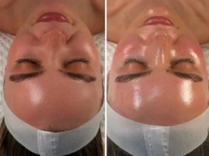 Hydrafacial 7