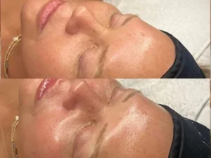 Hydrafacial 8