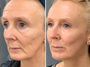 RF microneedling Skingenuity