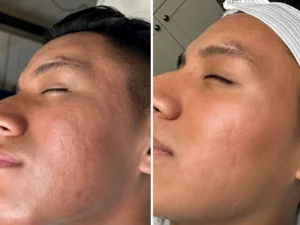 SkinPen