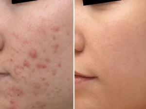 SkinPen Rejuran salmon sperm
