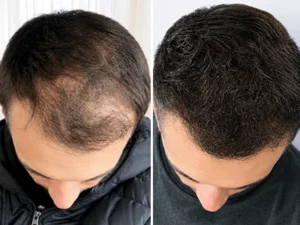 Hair growth